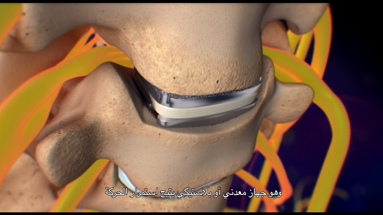 Cervical Disc Removal