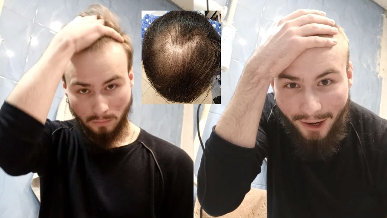 BALDING AT 19 - Dealing With Going Bald Young And Shaving My Head