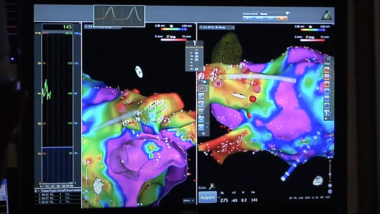 Convergent Procedure for Afib (HB 350)
