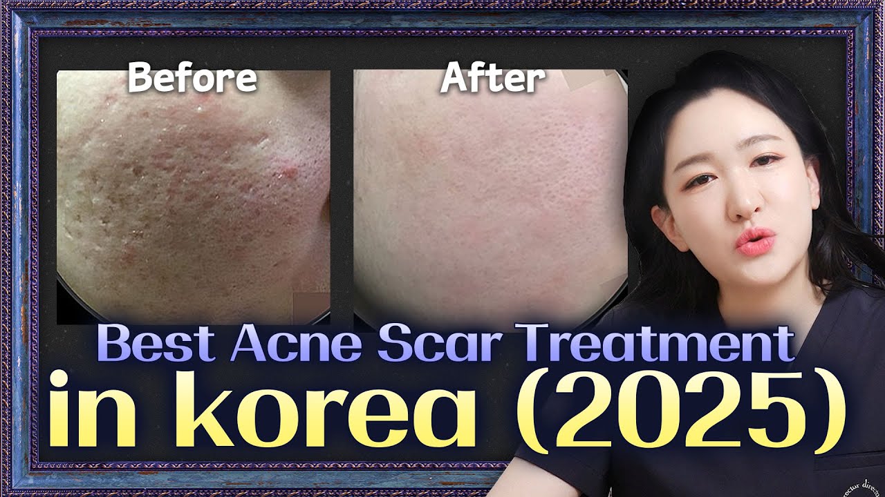 Korean-Style Acne Scar Treatment (Dermatologist Explains)