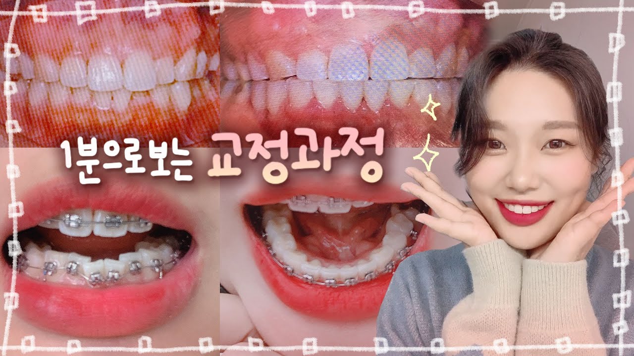 🦷1분 안에 2년 반 동안의 교정 과정 몰아보기😬