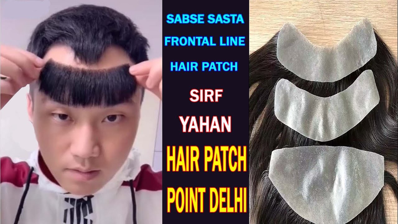 front hair line hair patch point delhi Con.9310355597
