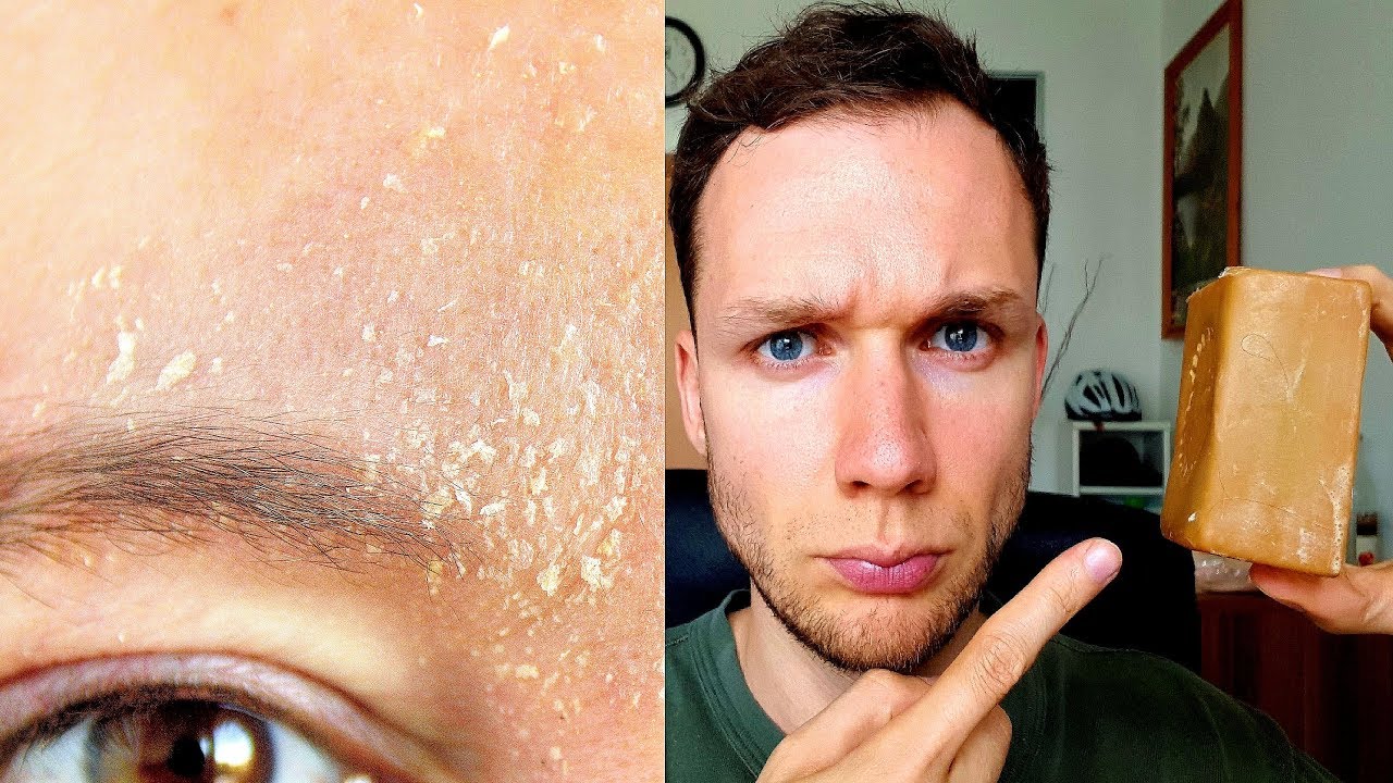 EXTREM schuppende trockene Haut im GESICHT! Lösung: Aleppo Seife von Carenesse
