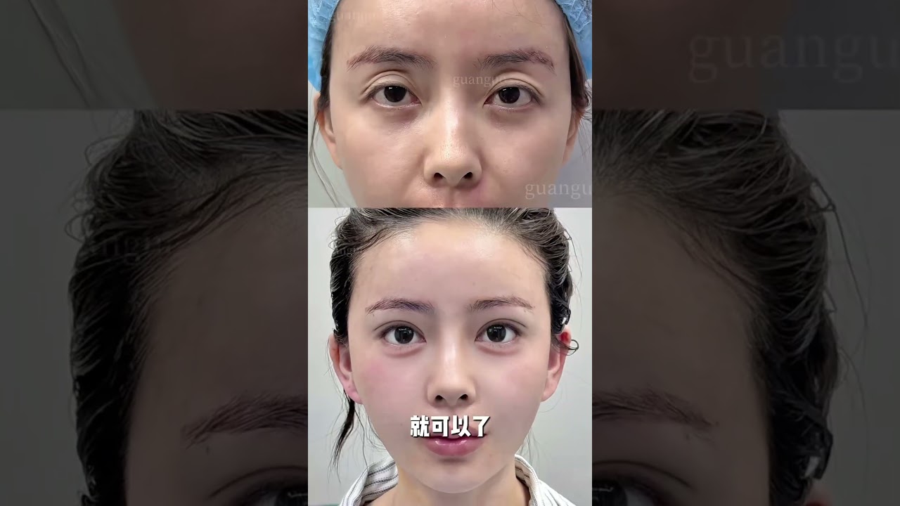 #facelift #liftingwajah #perawatankulitwajah #kecantikan #transformasidiri