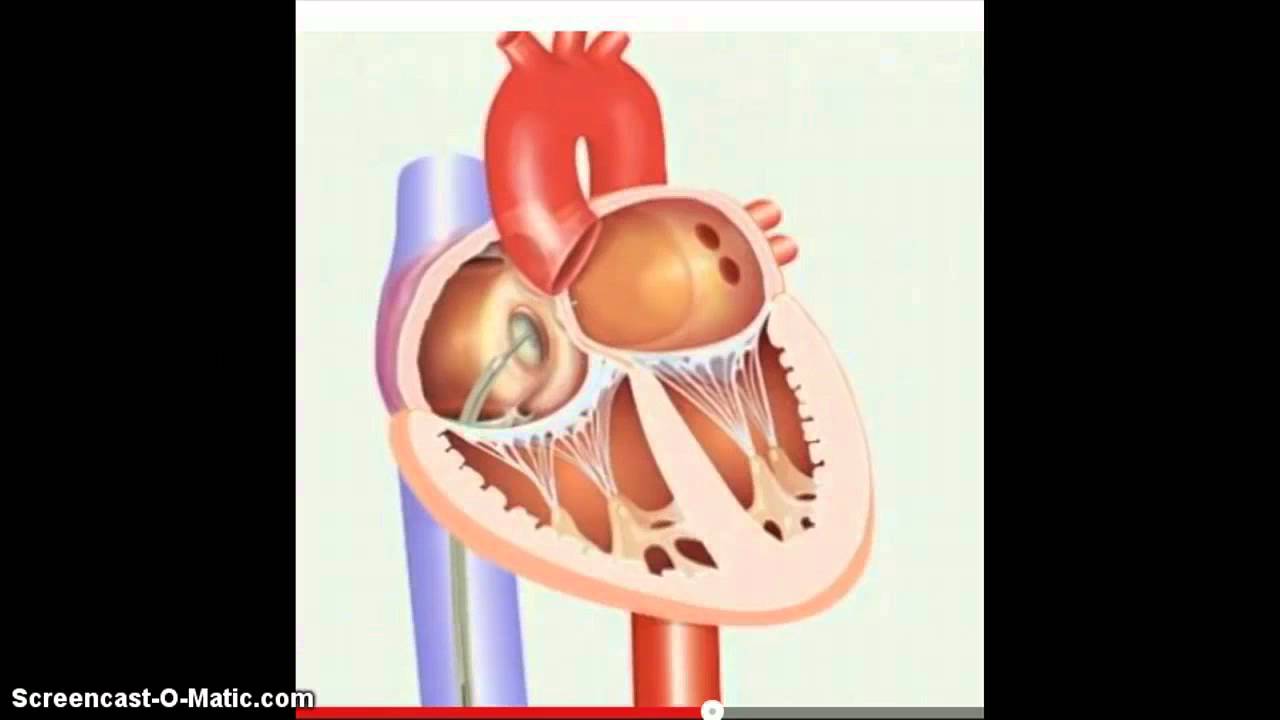 Percutaneous Ventricular Assist Device