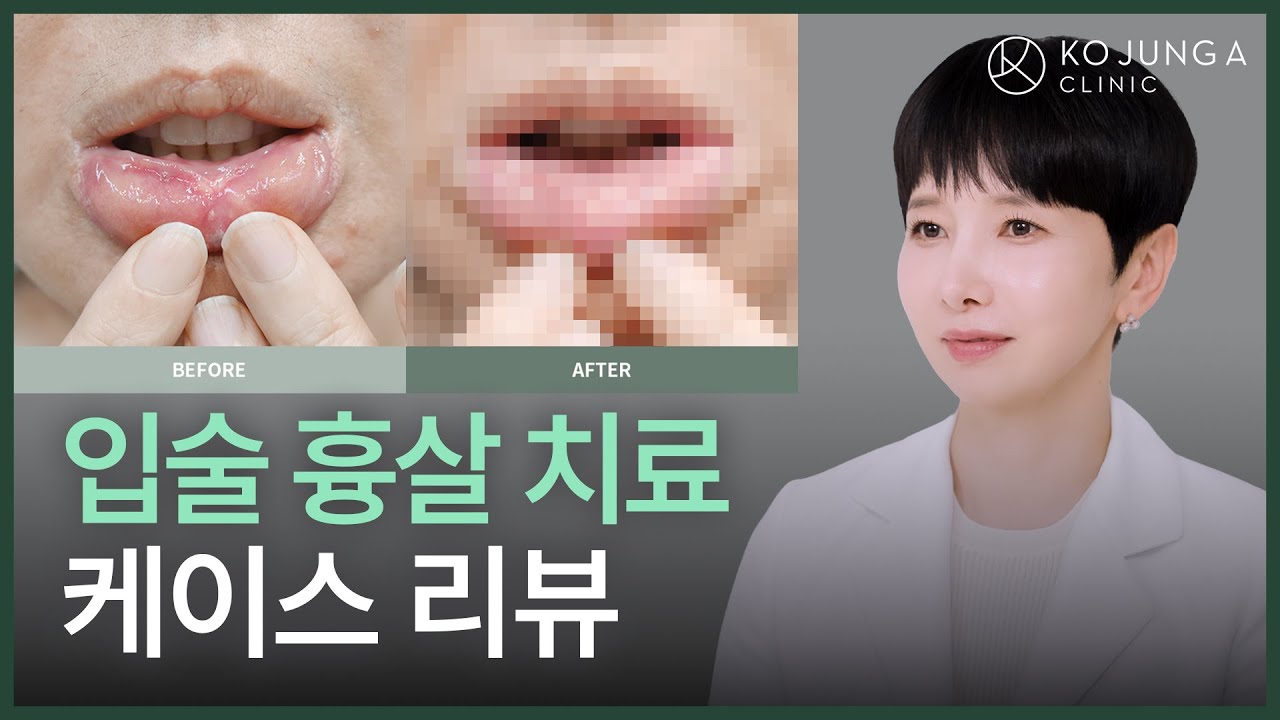 입술수술 후 입이 벌어지지 않는다면? 입술점막전진술·입꼬리수술 후유증 흉살·유착 치료 방법
