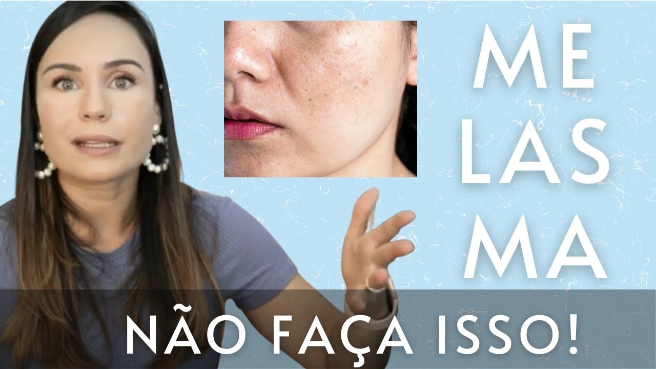 MELASMA? Não cometa esses ERROS!