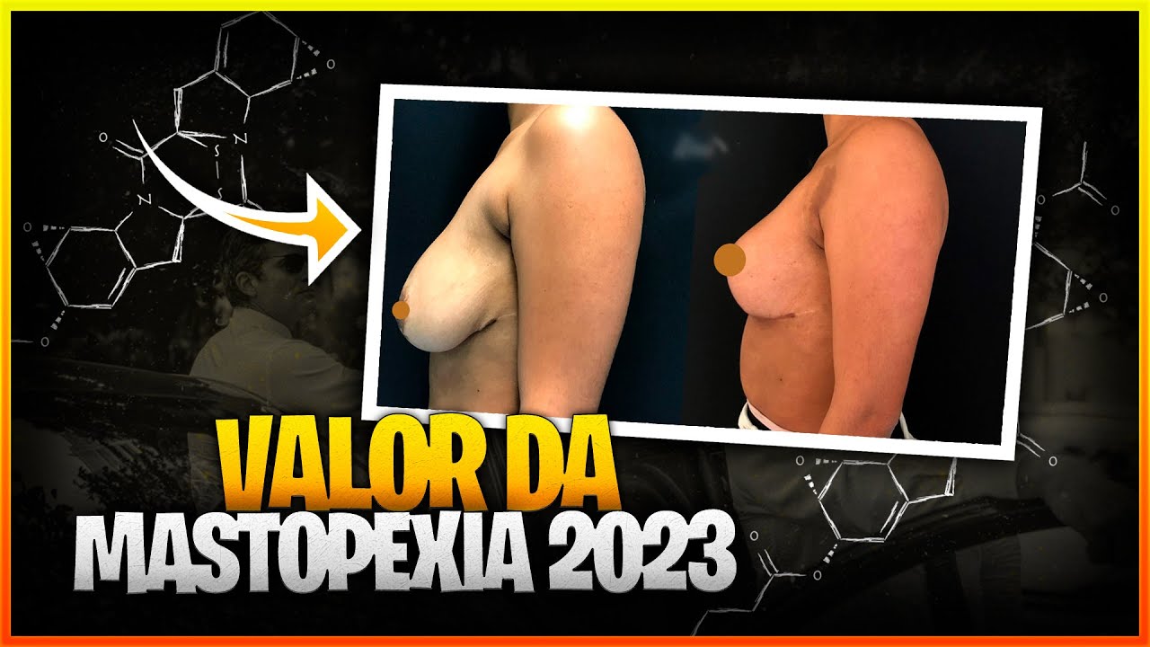 VALOR DA MASTOPEXIA PARA 2023 