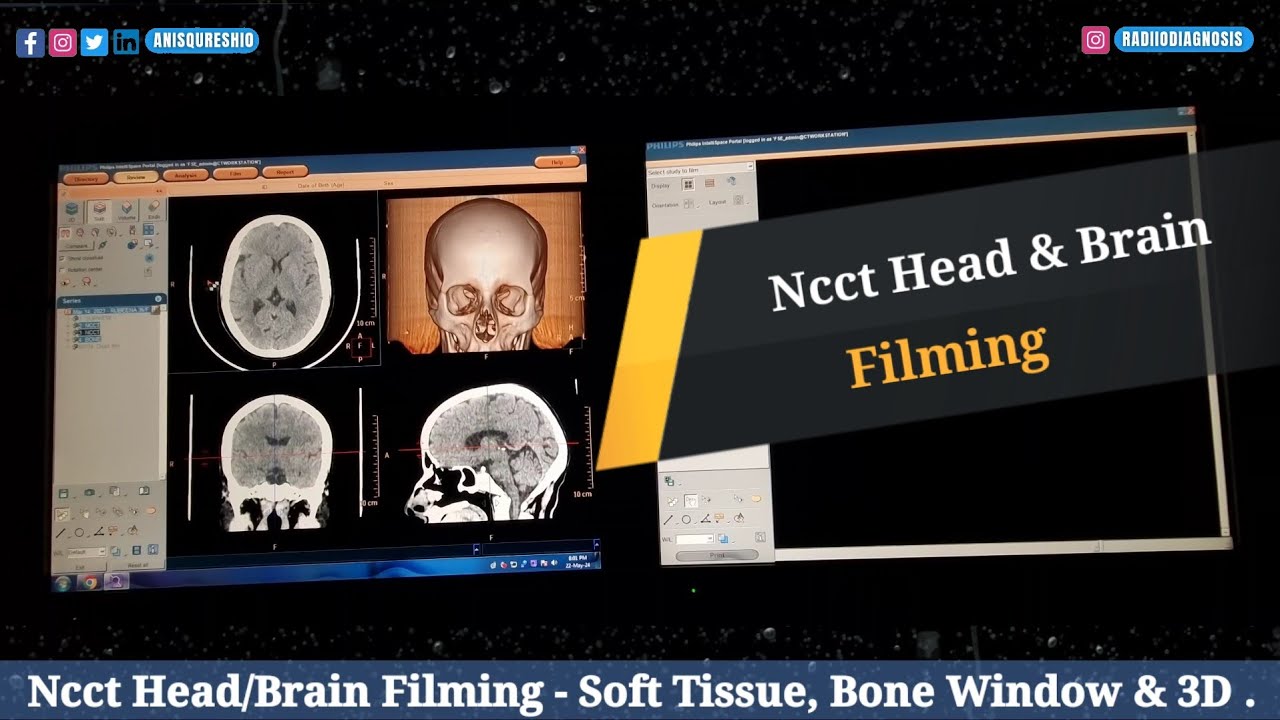 Ncct Head - Brain Filming | Axial, Coronal,  Sagittal & 3D  By Anis Qureshi