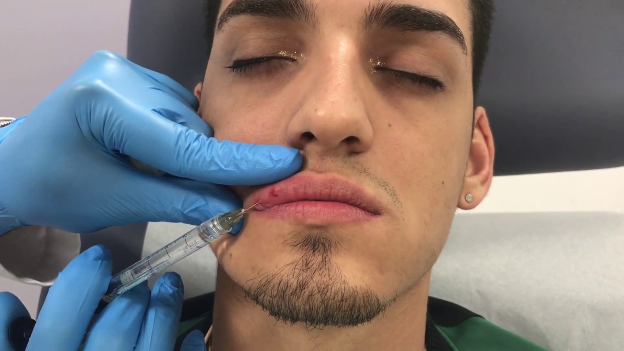 Restylane Defyne lip filler treatment in a male patient by Dr. Shaun Patel