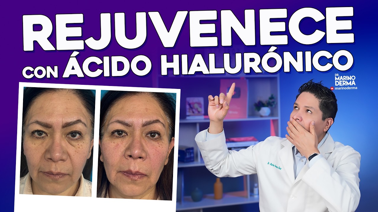 REJUVENECE CON ÁCIDO HIALURÓNICO. Consejos de un dermatólogo
