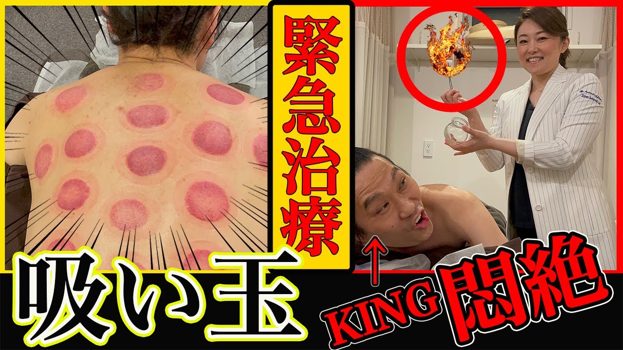 【札幌 吸い玉】美容鍼キングに火の吸い玉でガッツリ治療!!【札幌 美容鍼 妊活治療】