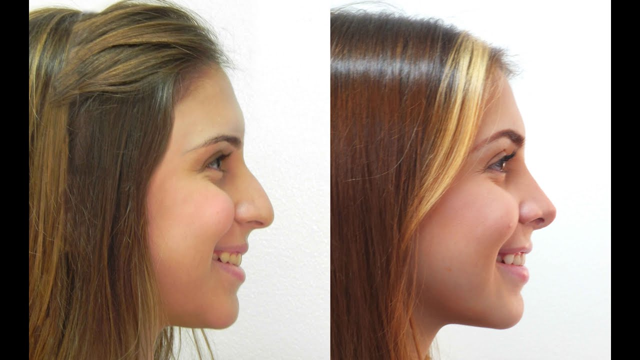 Rinoplastia Boris Henríquez Cirujano Plástico Barranquilla Colombia Cirugía Estetica Nariz