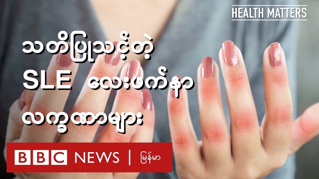 သတိပြုသင့်တဲ့ SLE လေးဖက်နာ လက္ခဏာများ - BBC News မြန်မာ