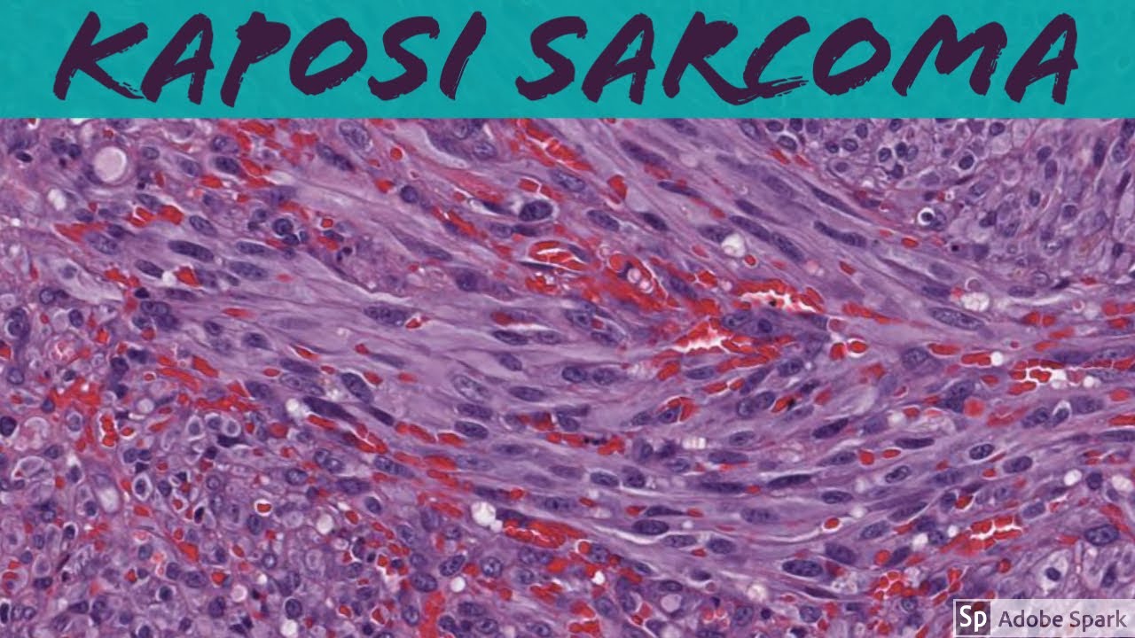 Kaposi Sarcoma: 5-Minute Pathology Pearls