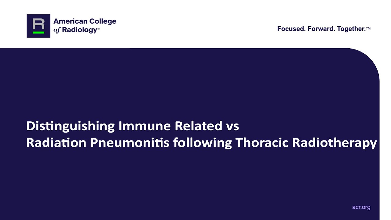 Distinguishing Immune Related vs  Radiation Pneumonitis following Thoracic Radiotherapy