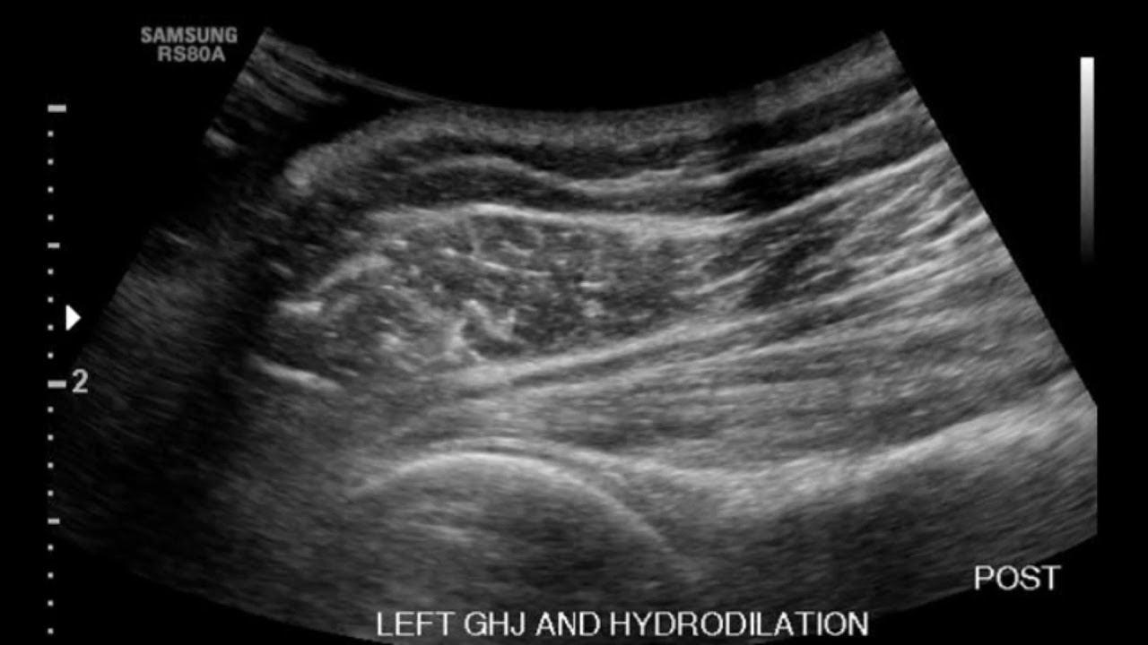 Shoulder Ultrasound: Demonstration of Needle Placement