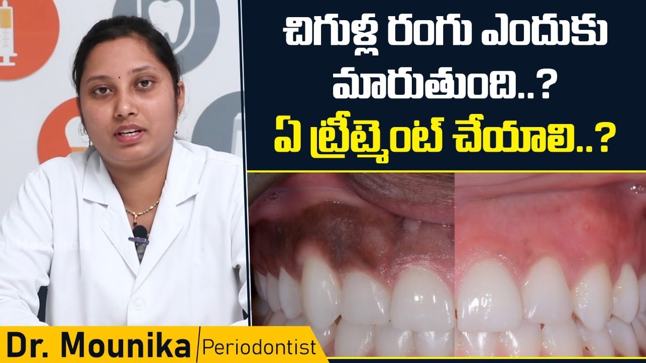 చిగుళ్లు రంగు మారితే | Causes And Treatment For Gum Pigmentation || Eledent Dental Hospitals