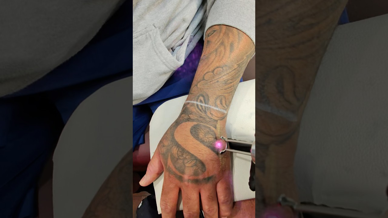 Laser Tattoo Removal 