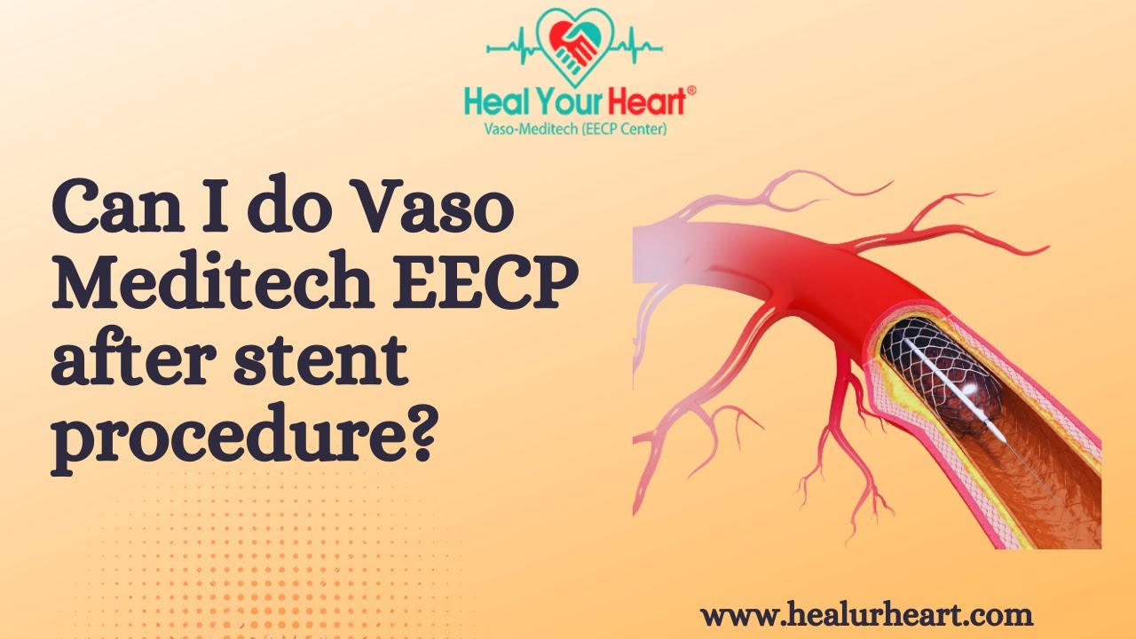 Can I do Vaso Meditech EECP after stent procedure?
