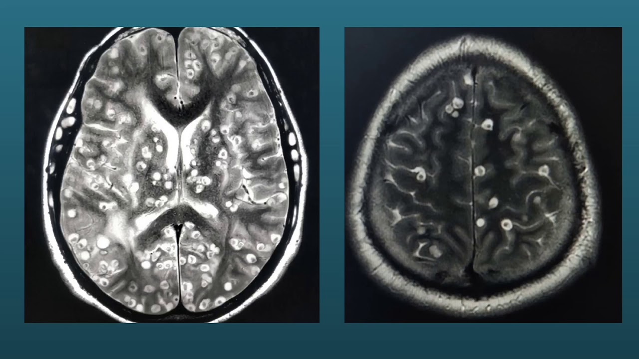 NEUROCYSTICERCOSIS & MYOCYSTICERCOSIS|| NEUROINFECTIONS|#YOUTUBERADIOLOGYSHORTS|OCULARCYSTICERCI