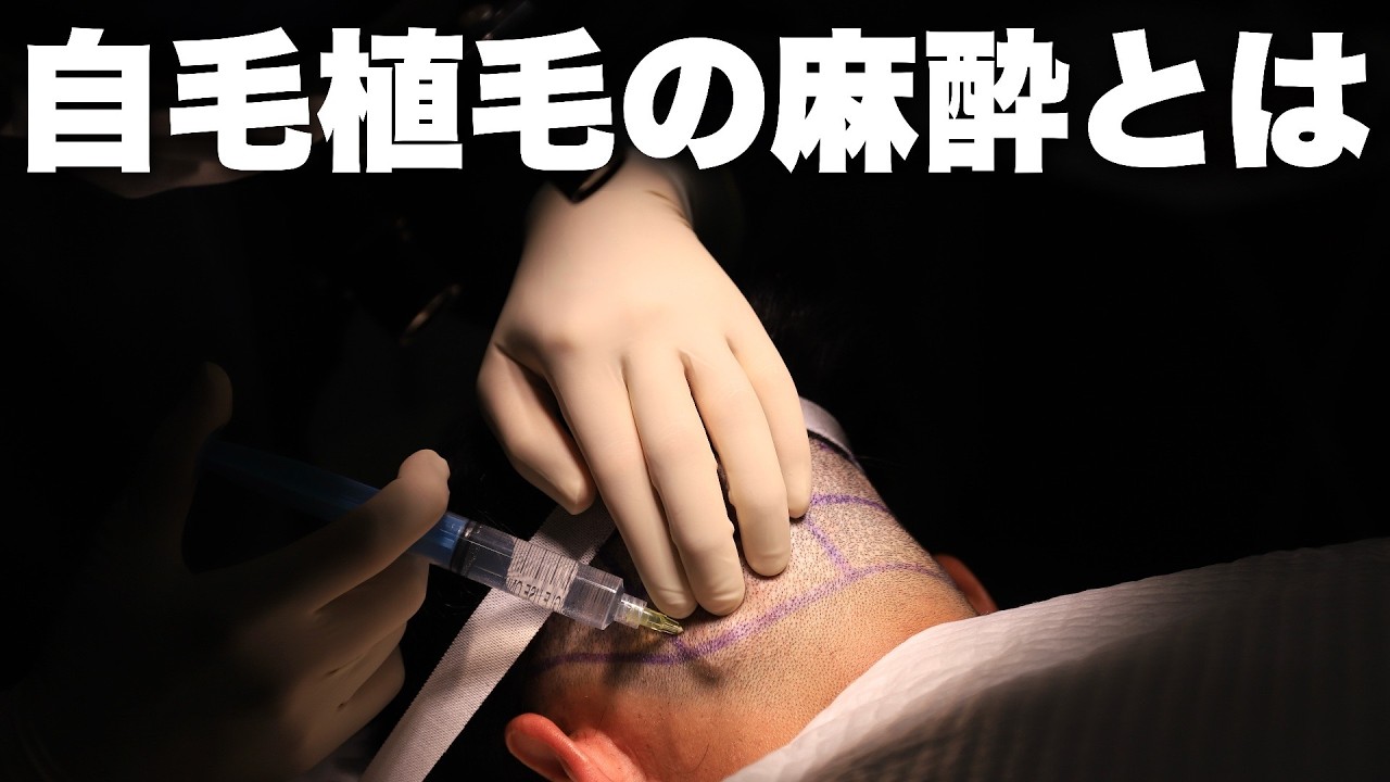 【無痛？痛い？】自毛植毛の麻酔について解説