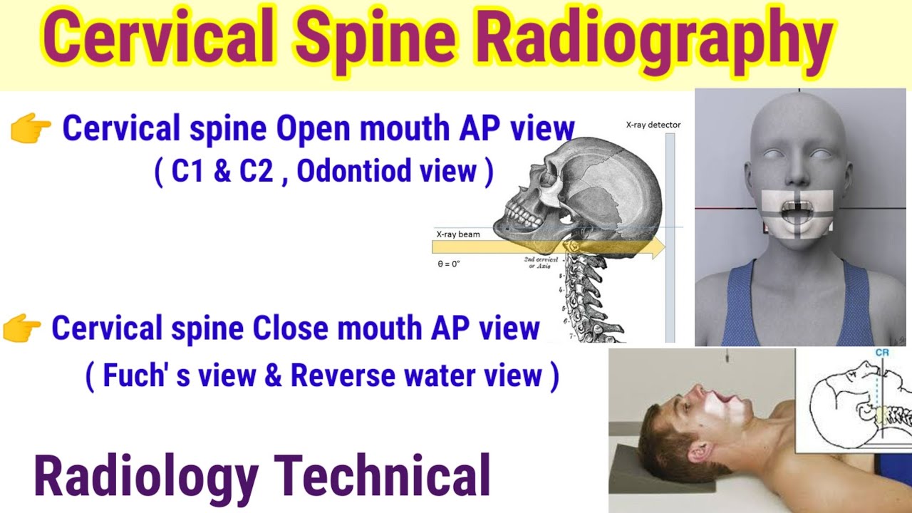 Cervical spine Open mouth AP view # Close month AP View X-ray # Odontoid view & Fuchs view x-ray #