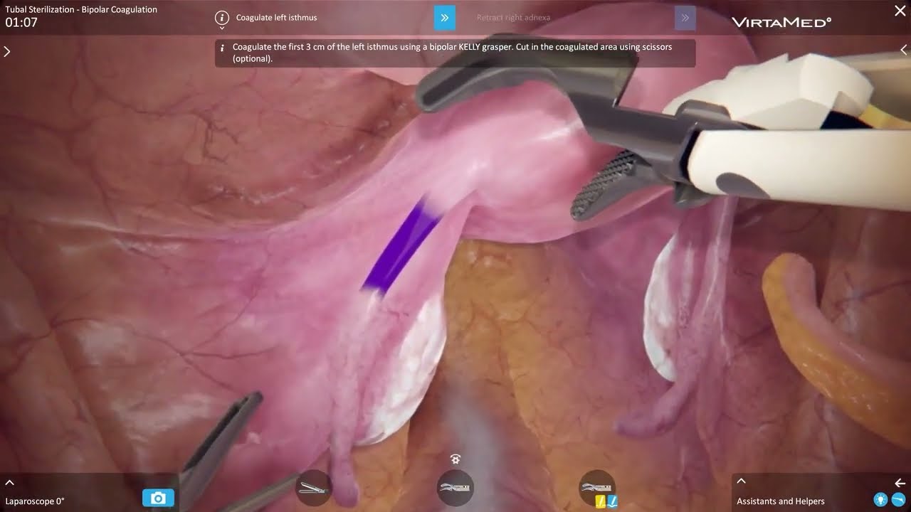VirtaMed LaparoS&trade; - Tubal Sterilization Bipolar Coagulation