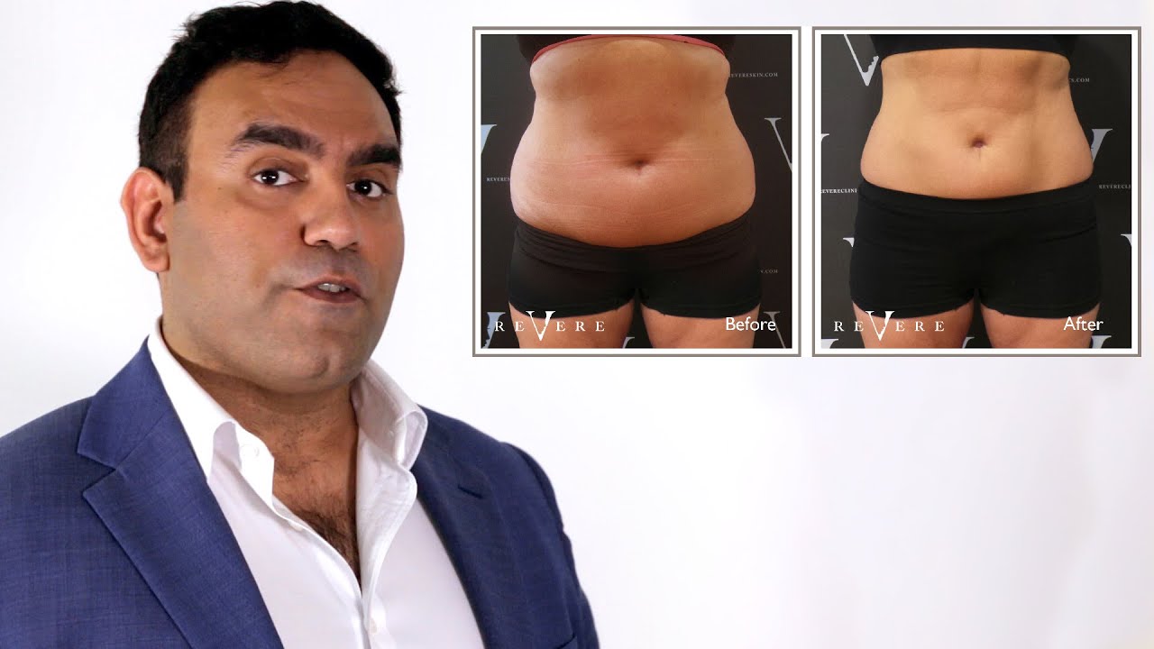 The True Cost of CoolSculpting | Revere Clinics