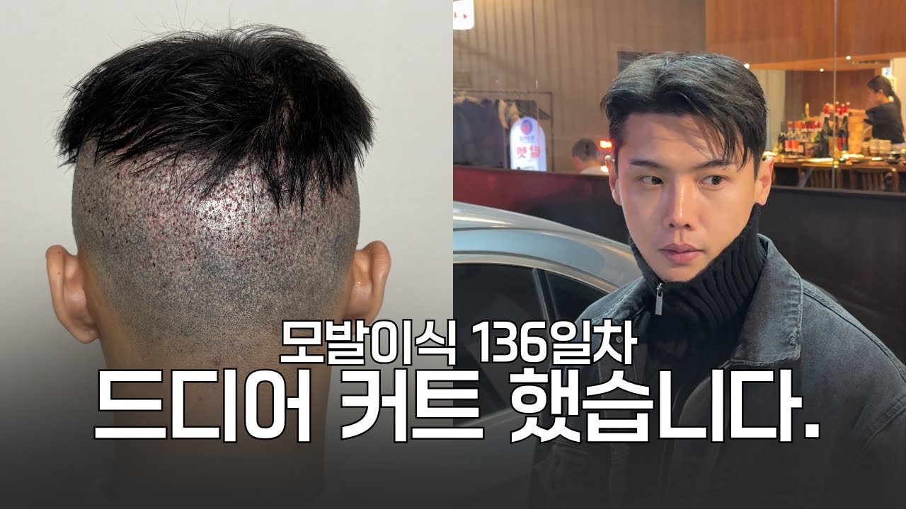 모발이식 136일차 브이로그