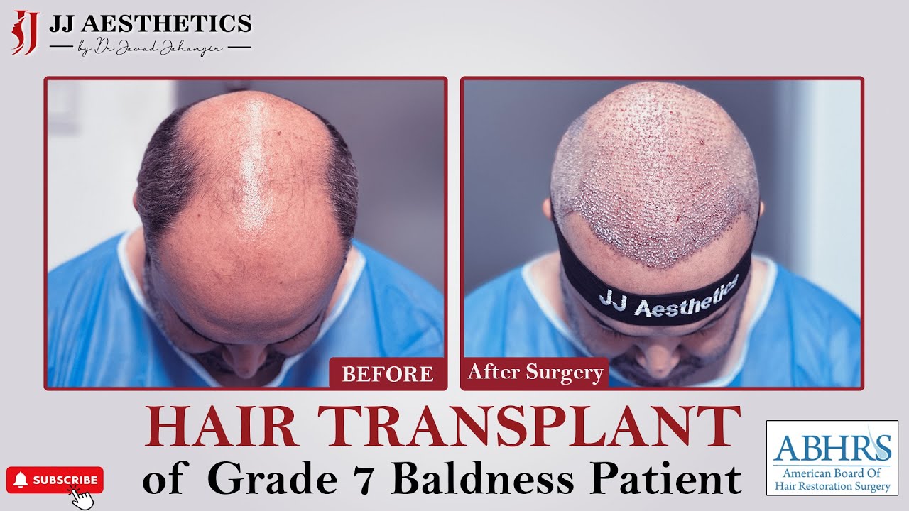 Grade 7 Baldness Hair Transplant Surgery Transformation Pakistan