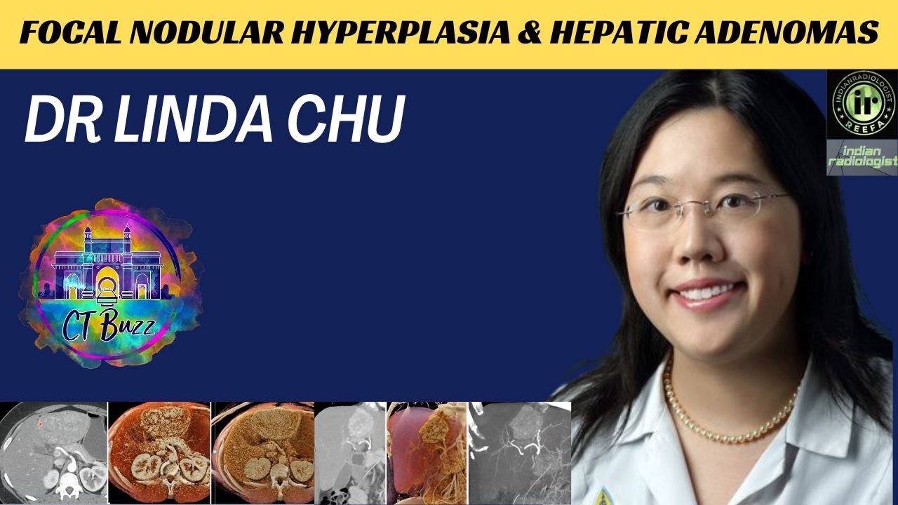 DR LINDA CHU | FOCAL NODULAR HYPERPLASIA & HEPATIC ADENOMAS