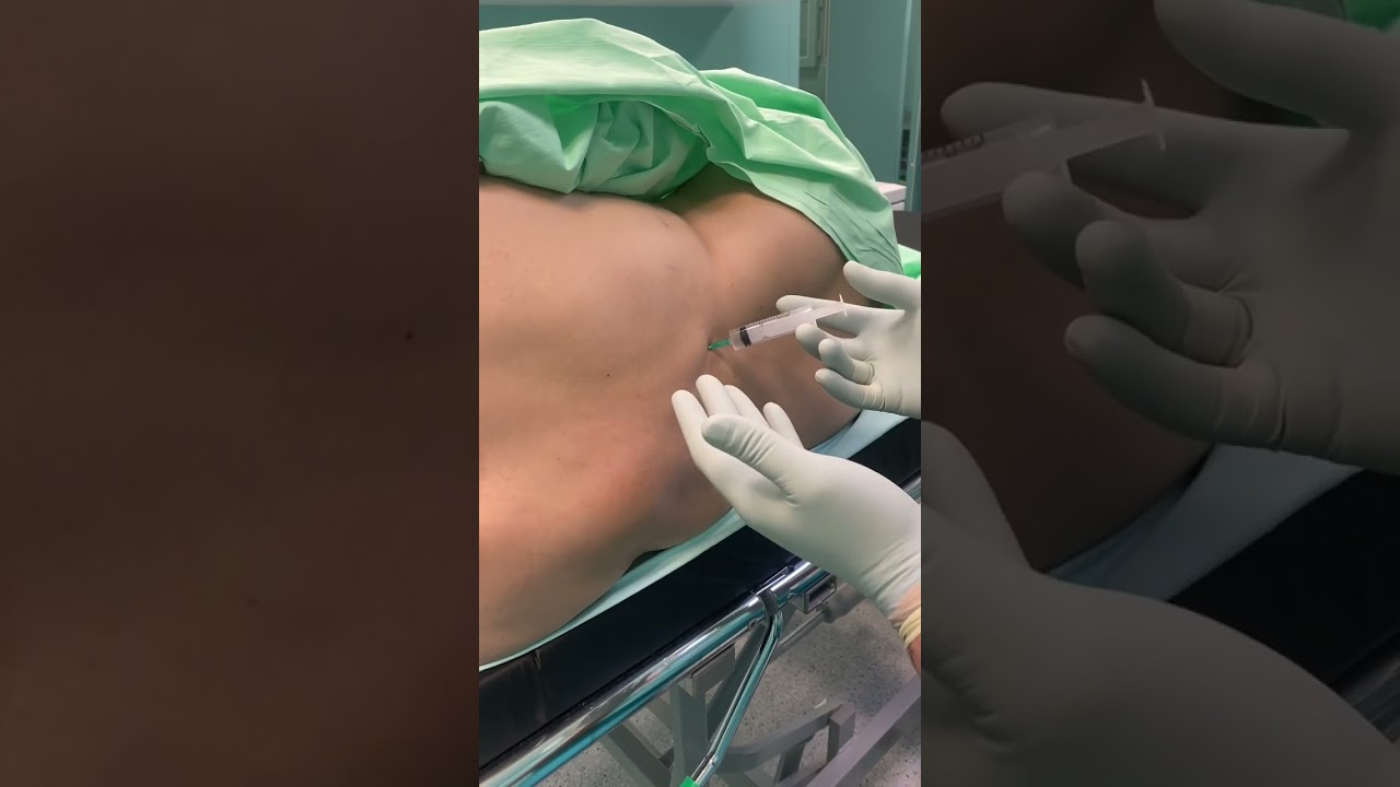 #Epidural #catheter #adti #uzbekistan #andijan #russia #usa #canada #anesthesia #anesthesiology #ane