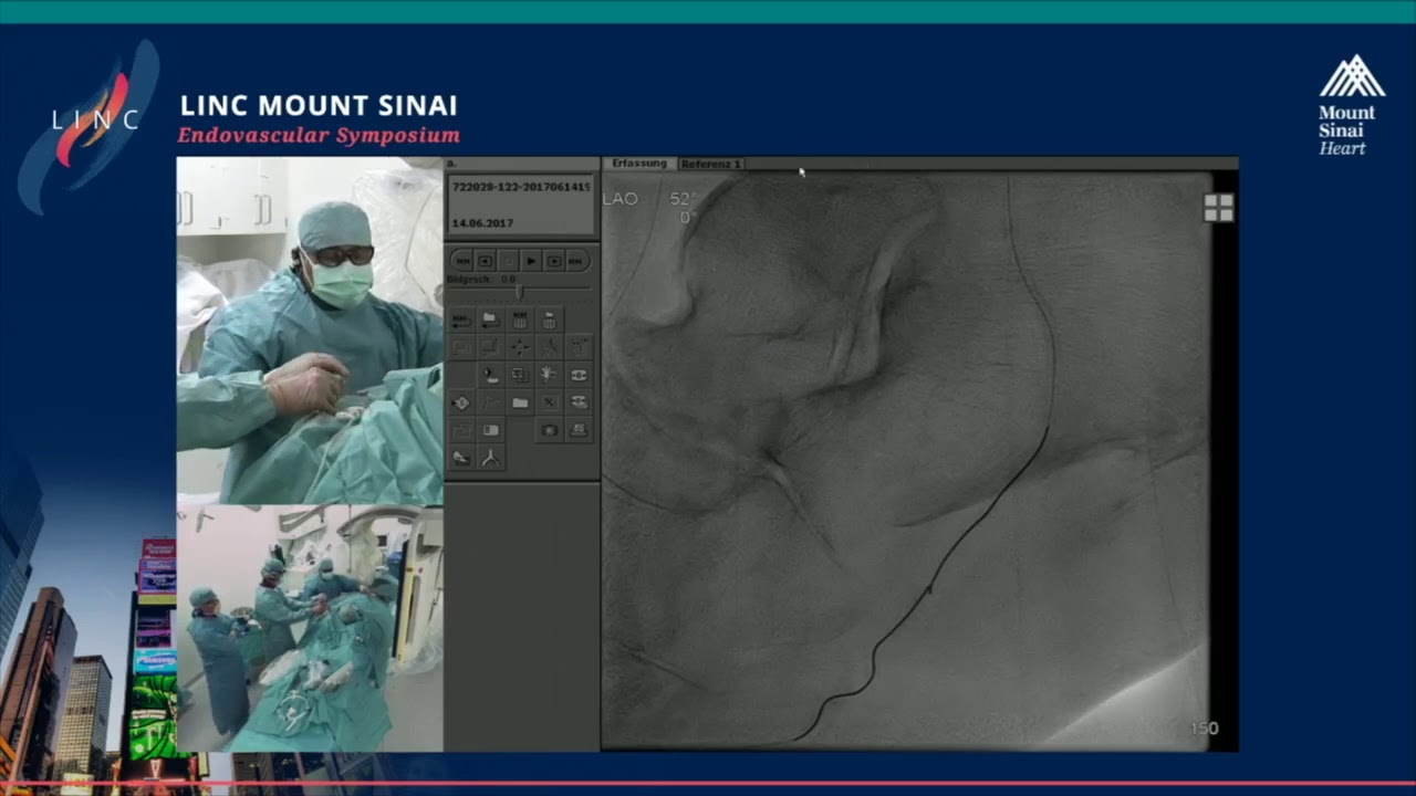 Live Case Presentation #14 TREATMENT OF COMPLEX TIBIO PEDAL STENOSIS FOR CRITICAL LIMB ISCHEMIA