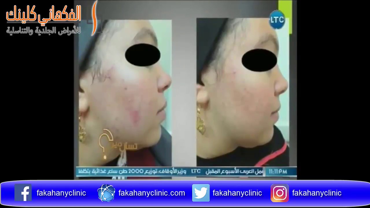 افضل علاج لاثار حب الشباب مع دكتور حسن الفكهاني في برنامج تسأل مين الموسم الثاني ح 5