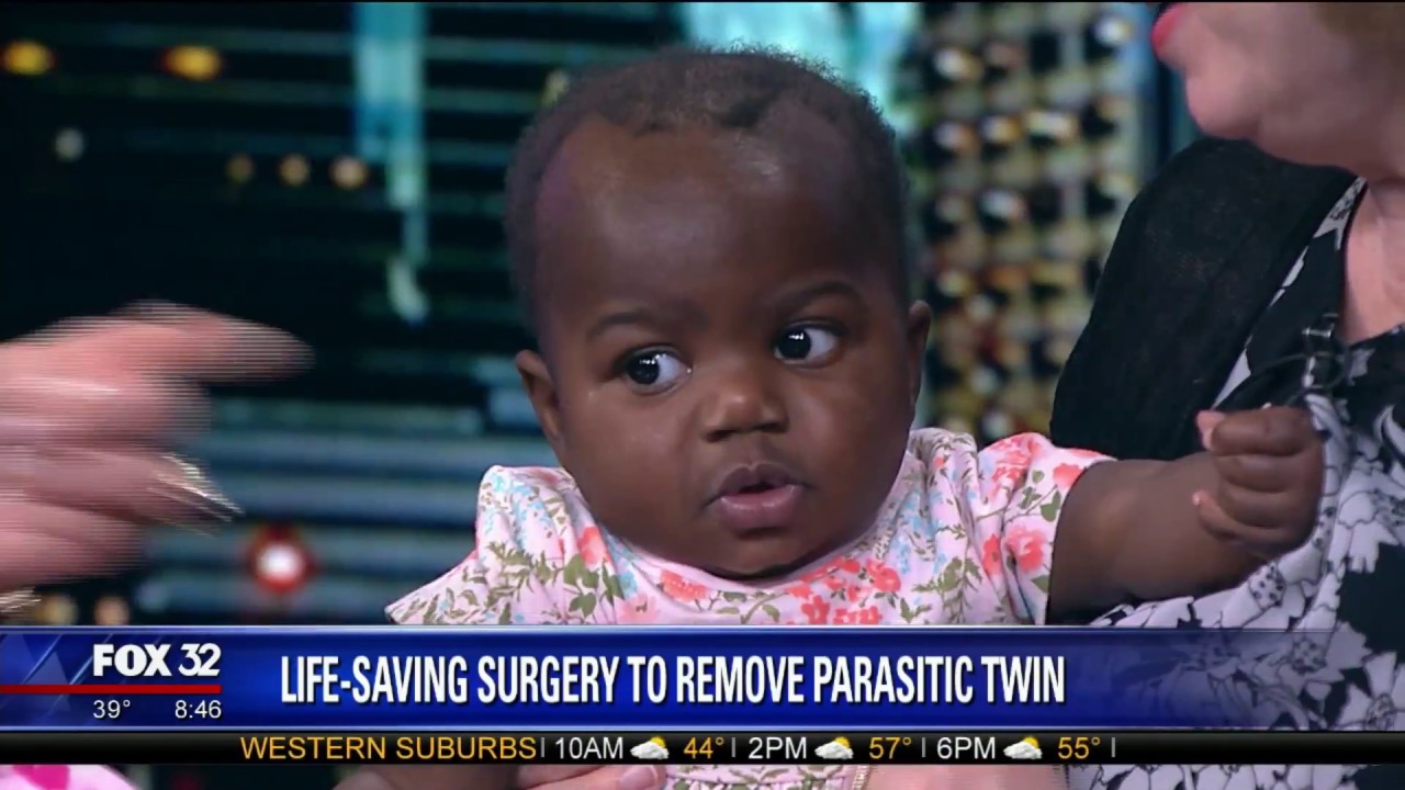 Baby Dominique Receives Life-Saving Surgery To Remove Parasitic Twin