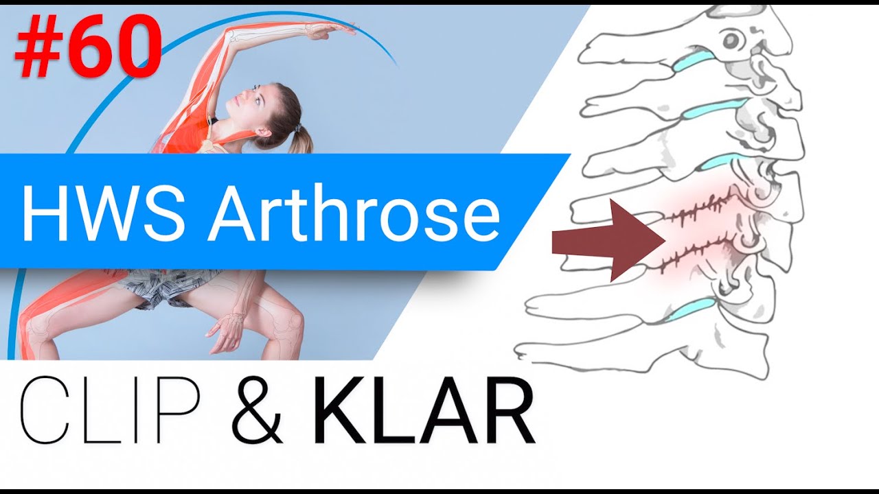 HWS Arthrose erkl&auml;rt - Verschleiss in der Halswirbels&auml;ule