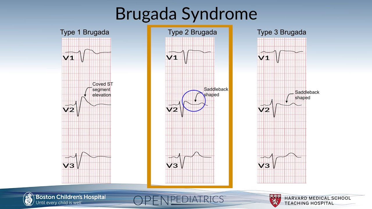 Brugada Syndrome by G. Dhillon | OPENPediatrics