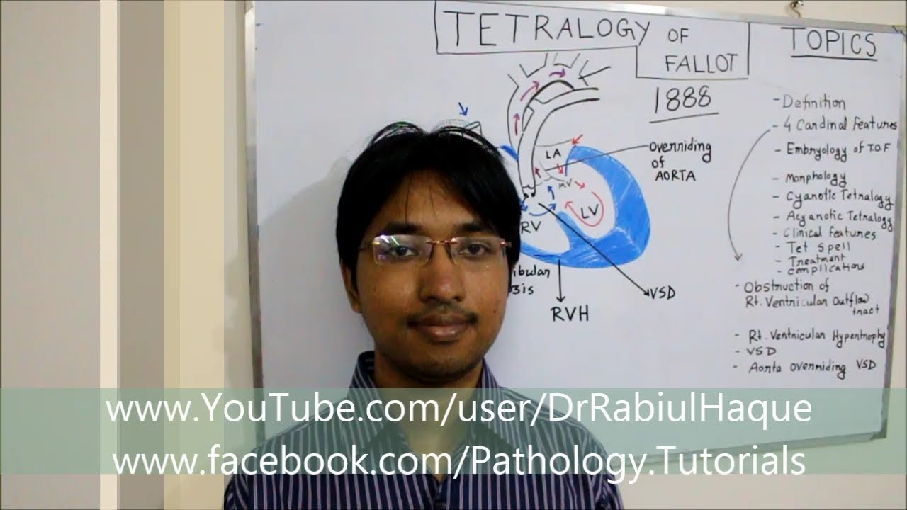 Tetralogy of Fallot (HD)