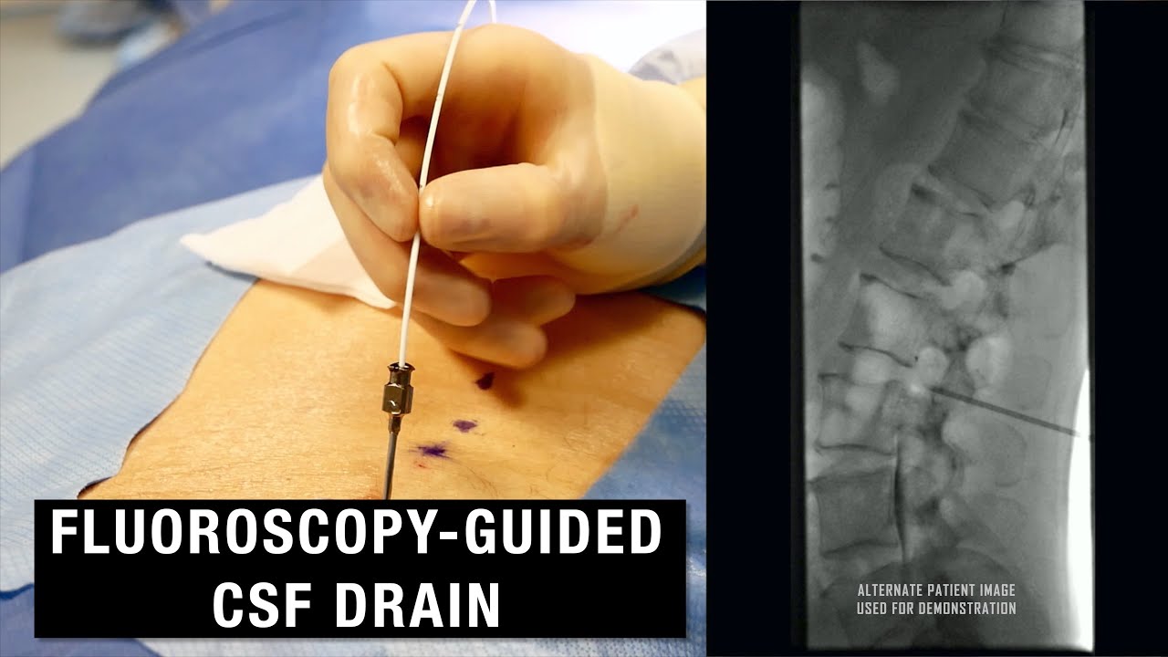 Fluoroscopy-Guided CSF Drain (Spinal Drain) // Demo and Anatomy Review