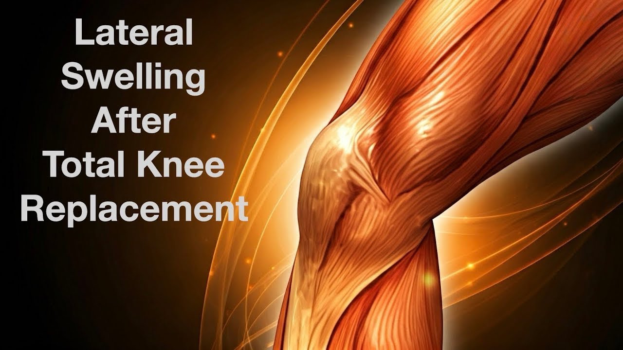 Lateral Swelling After Total Knee Replacement