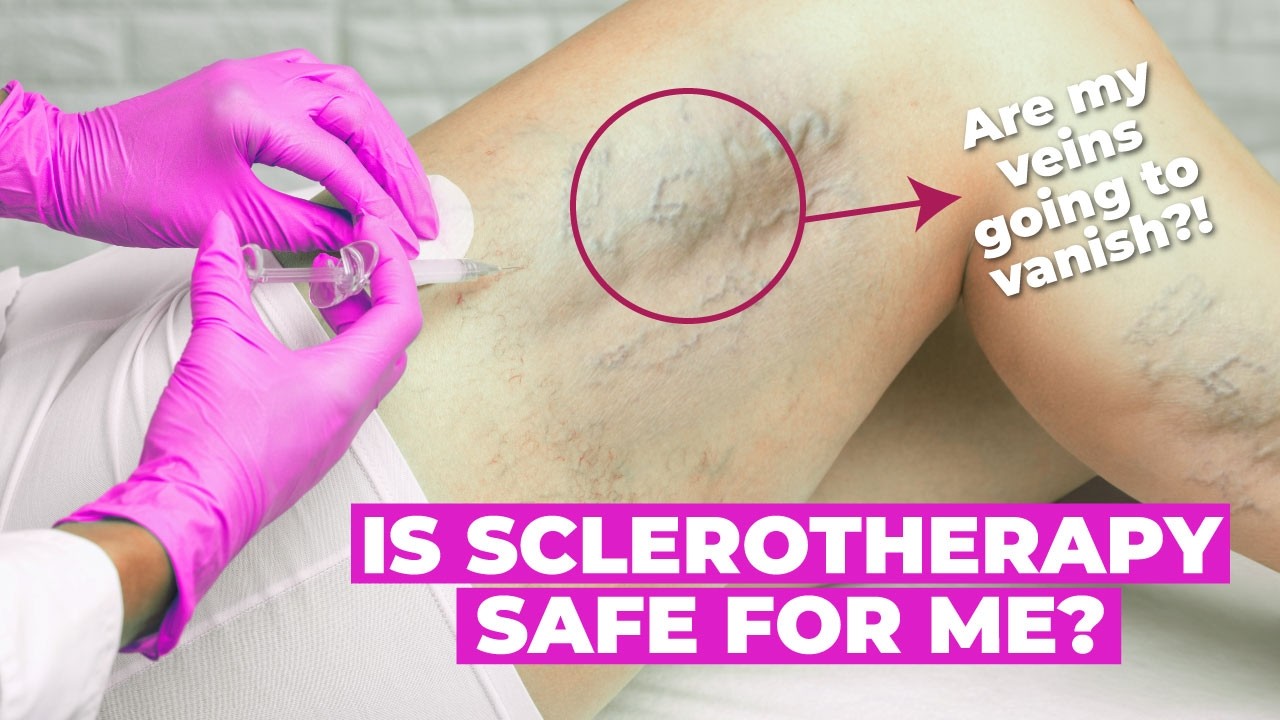 Is Sclerotherapy Safe? Risks, Benefits & What to Expect