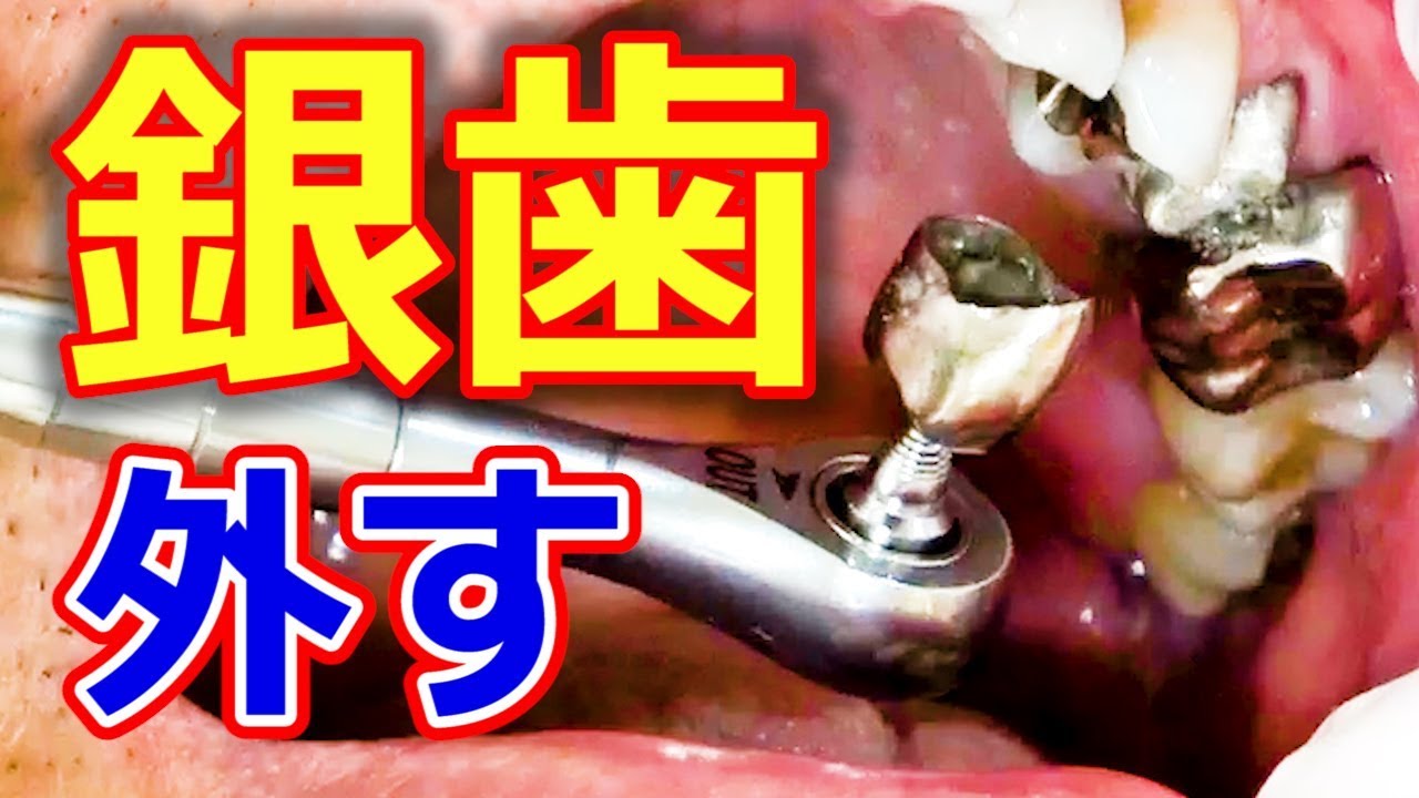 歯の銀の被せ物を外す様子