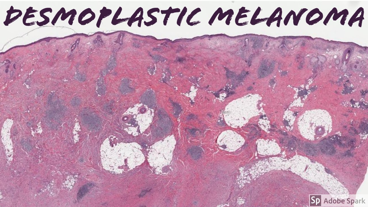 Desmoplastic Melanoma: 5-Minute Pathology Pearls