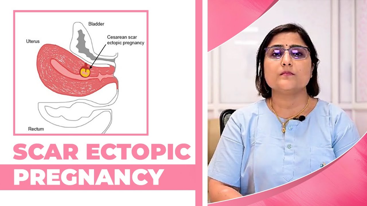 Scar ectopic pregnancy, यूटरस के टांको में प्रेगनेंसी का ठहराना