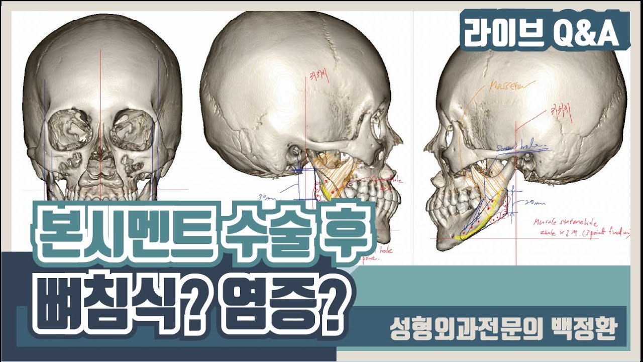 본시멘트 수술후 염증으로 뼈침식이 올 수도 있나요?