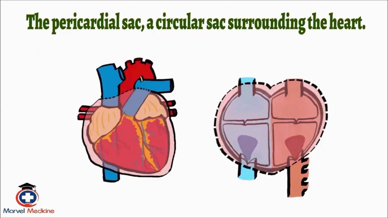 Cardiac Tamponade- Pulsus Paradoxus