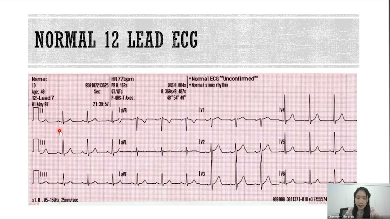 Cardiac Arrhythmia & Management โดยแพทย์หญิงชนกพร ลักขณานุรักษ์