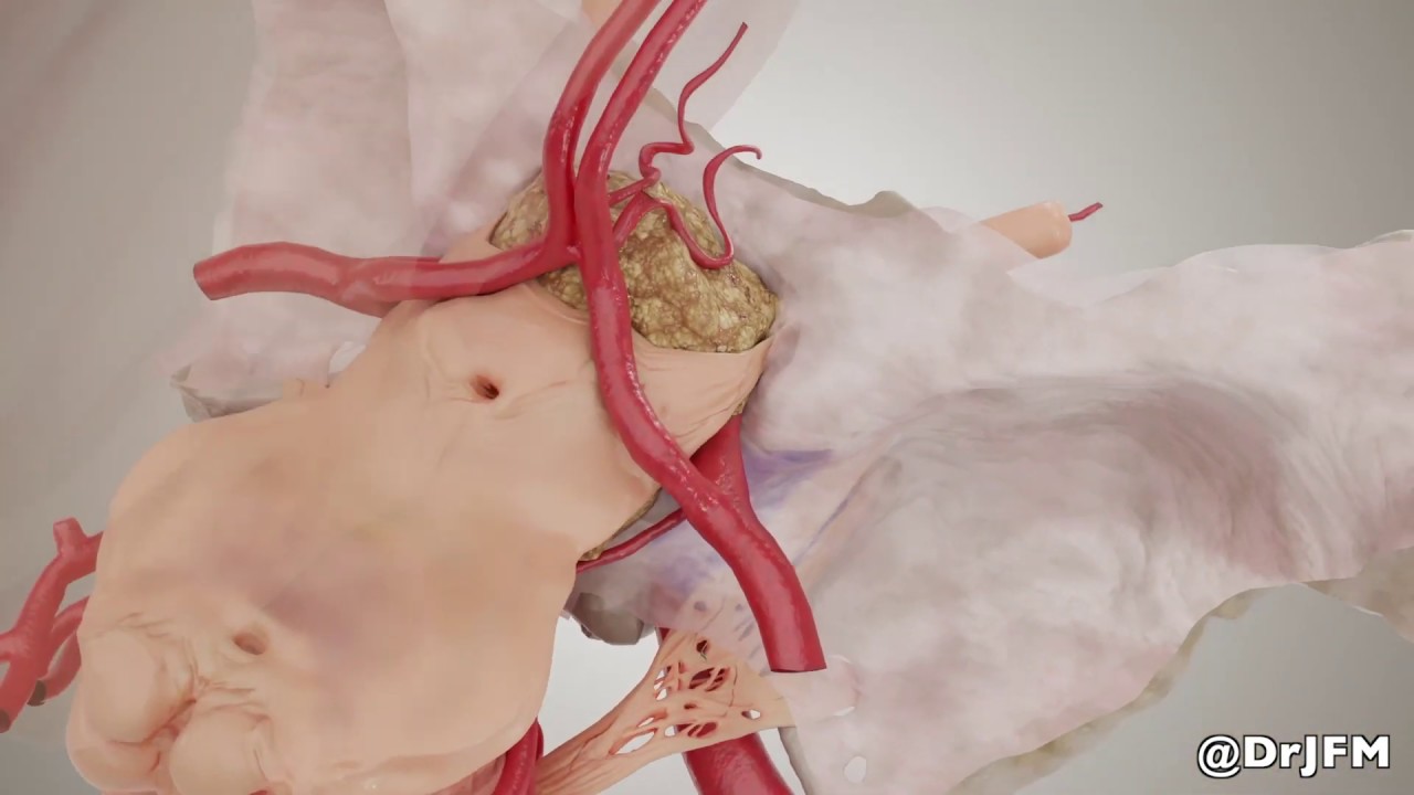 Skull Base Meningioma Animation