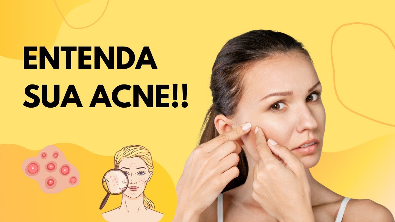 Acne: Classificação, Causas e Tratamentos